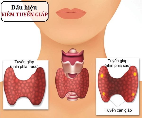 Viêm tuyến giáp: Nhận biết, nguyên nhân và điều trị | Bệnh viện ...